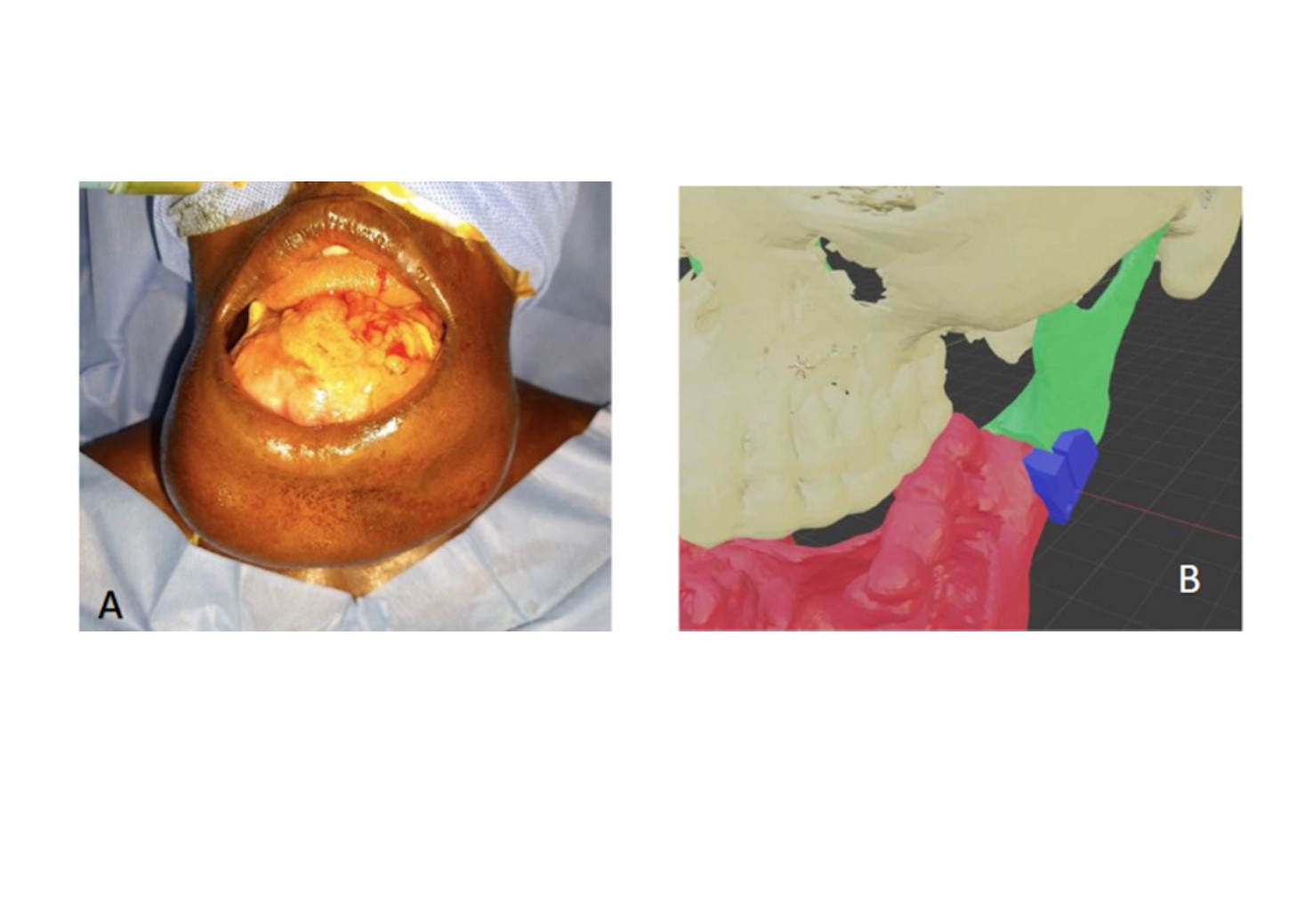 Ameloblastoma anterior pre and post reconstruction