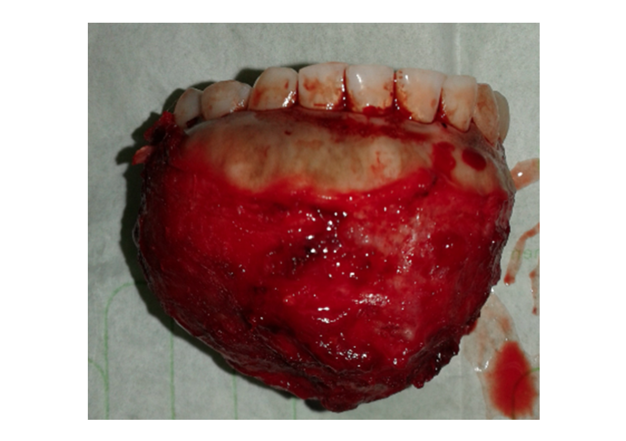 Resected mandibular ameloblastoma